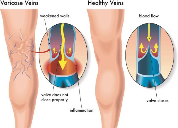 Causes Of Varicose Veins
