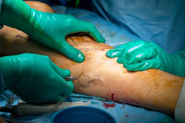 Varicose Veins Surgery