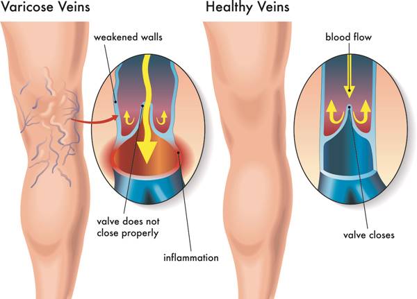 Are Varicose Veins Dangerous?